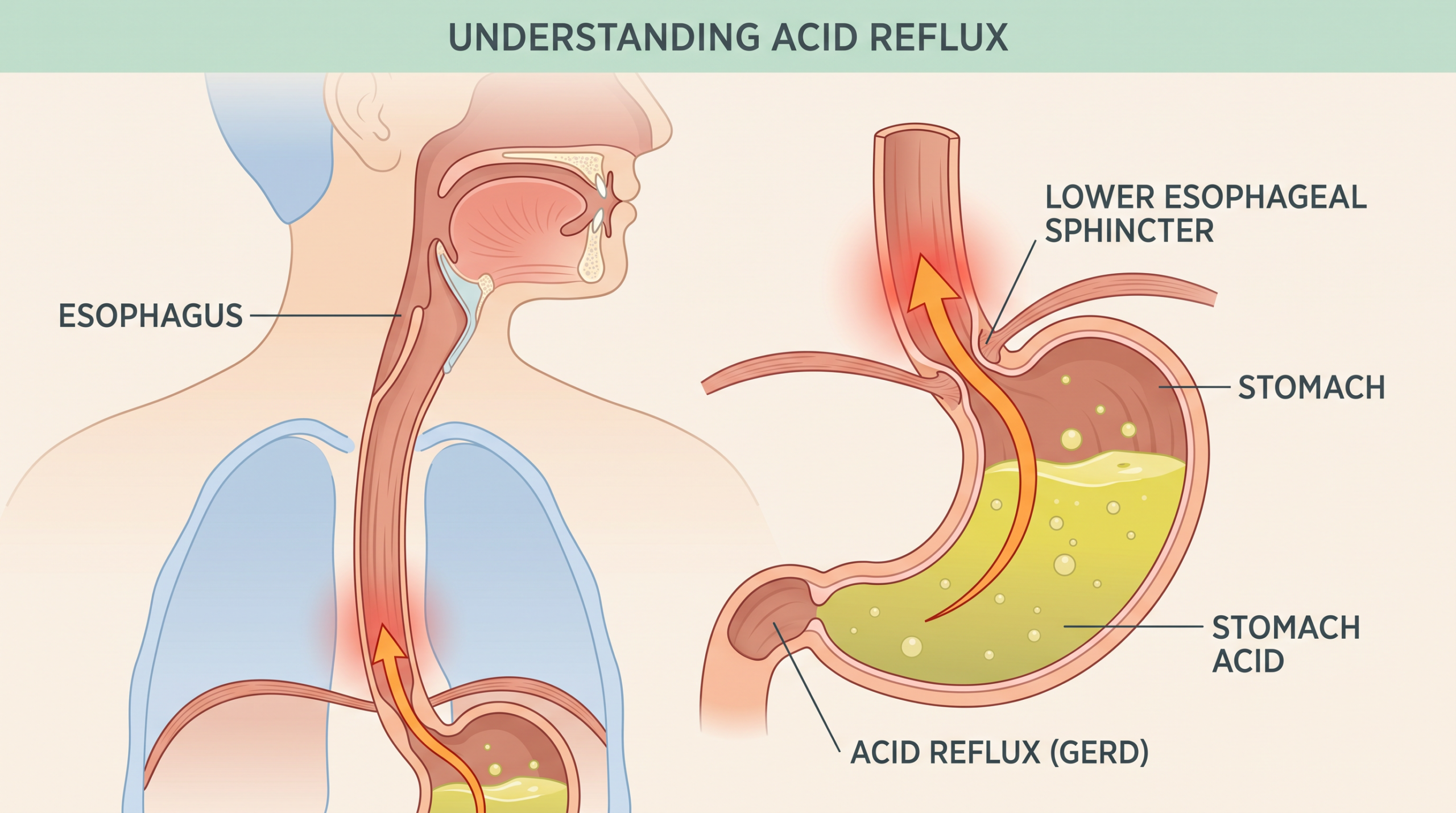 Understanding Acid Reflux Causes and Symptoms